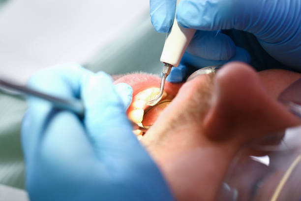 Best Emergency Root Canal Treatment in Ocean Springs, MS