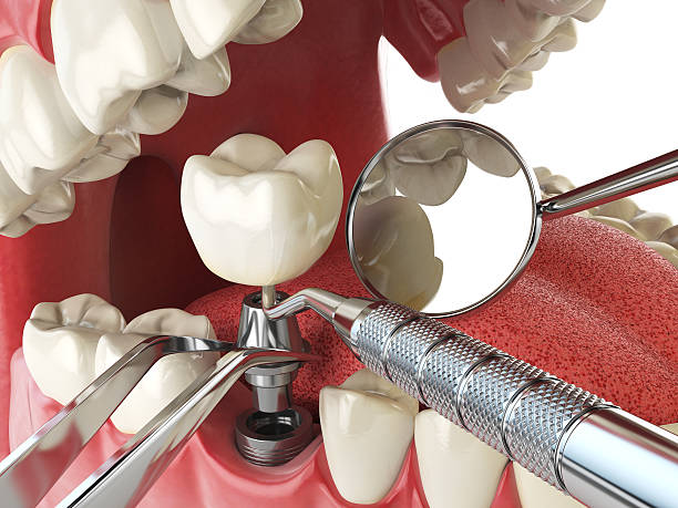 Best Emergency Tooth Extraction in Ocean Springs, MS